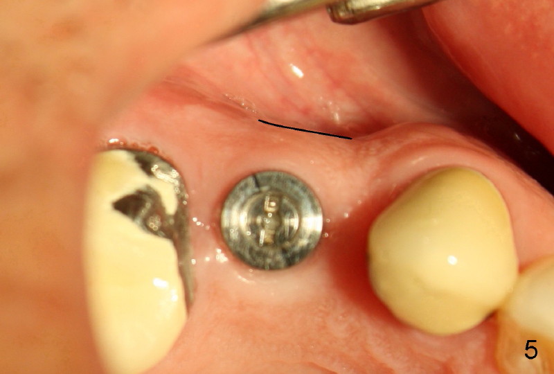 Implant is a Preventive Measure gum bone shrink after tooth extraction